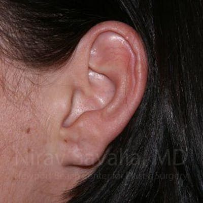 Torn Earlobe Repair / Ear Gauge Repair Before & After Gallery - Patient 1655797 - Image 2