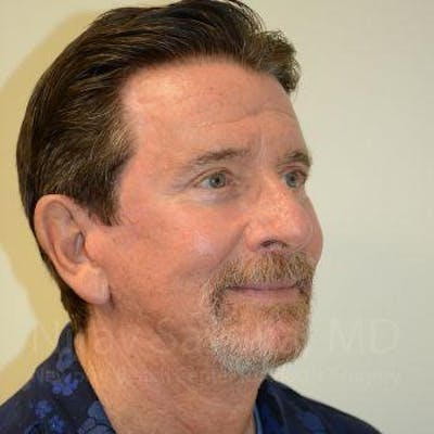 Eyelid Surgery Before & After Gallery - Patient 1655796 - Image 10