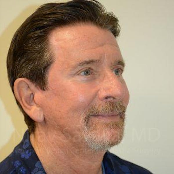 Eyelid Surgery Before & After Gallery - Patient 1655796 - Image 10