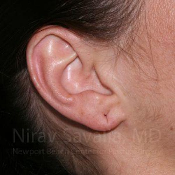 Torn Earlobe Repair / Ear Gauge Repair Before & After Gallery - Patient 1655797 - Image 3