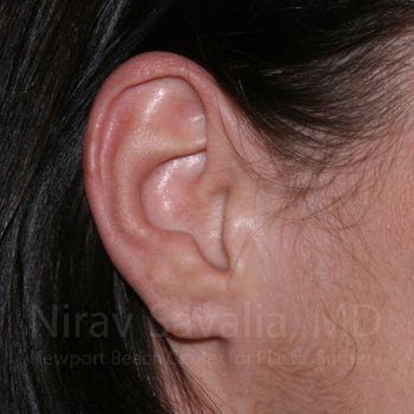 Torn Earlobe Repair / Ear Gauge Repair Before & After Gallery - Patient 1655797 - Image 4