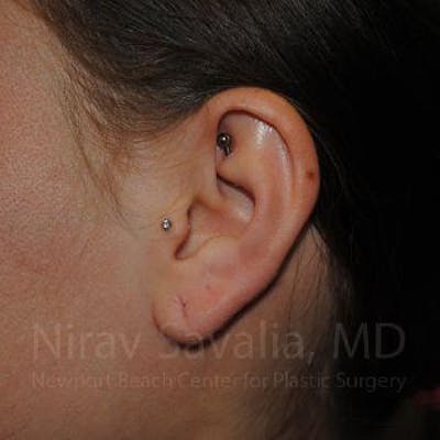 Torn Earlobe Repair / Ear Gauge Repair Before & After Gallery - Patient 1655798 - Image 1