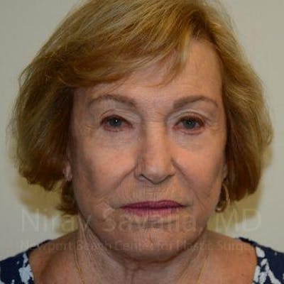 Eyelid Surgery Before & After Gallery - Patient 1655799 - Image 2