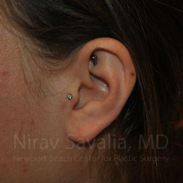 Torn Earlobe Repair / Ear Gauge Repair Before & After Gallery - Patient 1655798 - Image 2