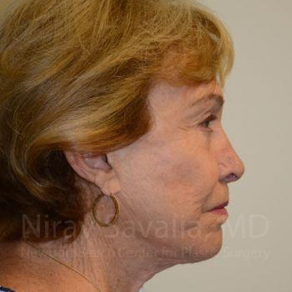 Eyelid Surgery Before & After Gallery - Patient 1655799 - Image 4
