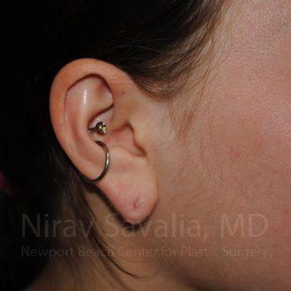 Torn Earlobe Repair / Ear Gauge Repair Before & After Gallery - Patient 1655798 - Image 3
