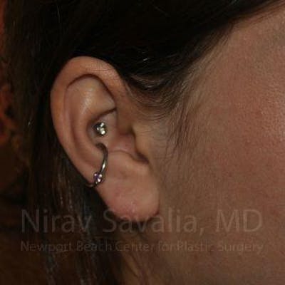 Torn Earlobe Repair / Ear Gauge Repair Before & After Gallery - Patient 1655798 - Image 4