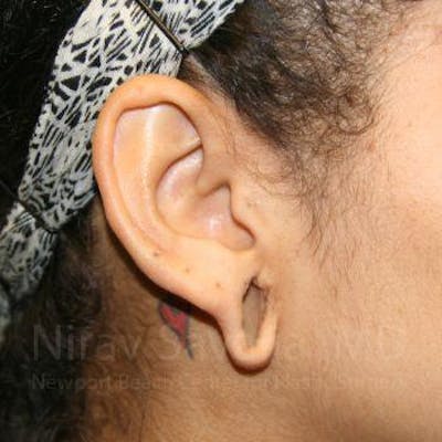Torn Earlobe Repair / Ear Gauge Repair Before & After Gallery - Patient 1655800 - Image 1