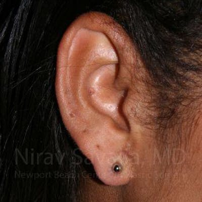 Torn Earlobe Repair / Ear Gauge Repair Before & After Gallery - Patient 1655800 - Image 2