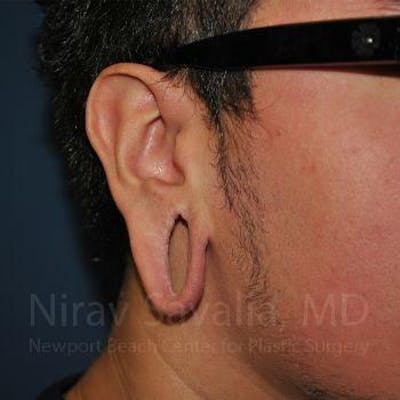 Torn Earlobe Repair / Ear Gauge Repair Before & After Gallery - Patient 1655801 - Image 1