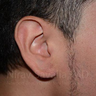 Torn Earlobe Repair / Ear Gauge Repair Gallery - Patient 1655801 - Image 2