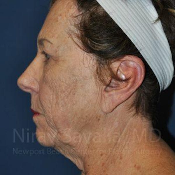 Eyelid Surgery Before & After Gallery - Patient 1655802 - Image 5