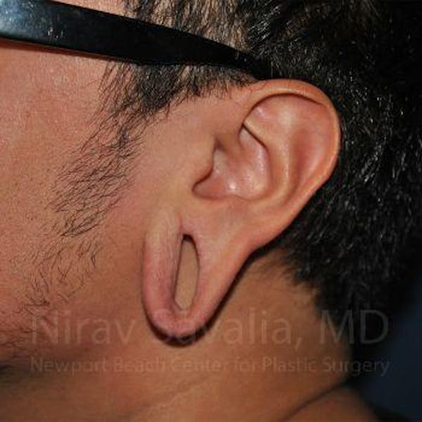 Torn Earlobe Repair / Ear Gauge Repair Before & After Gallery - Patient 1655801 - Image 3