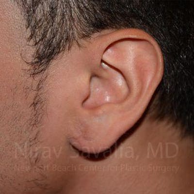 Torn Earlobe Repair / Ear Gauge Repair Before & After Gallery - Patient 1655801 - Image 4