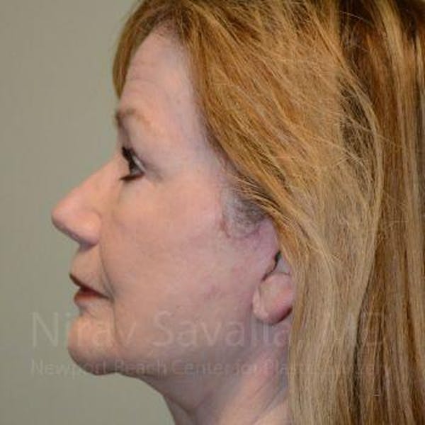 Eyelid Surgery Before & After Gallery - Patient 1655803 - Image 4