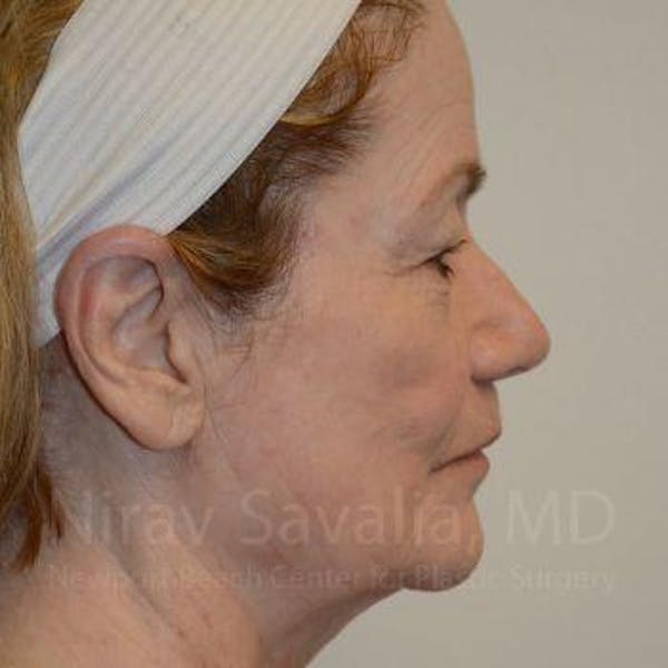 Eyelid Surgery Before & After Gallery - Patient 1655803 - Image 5