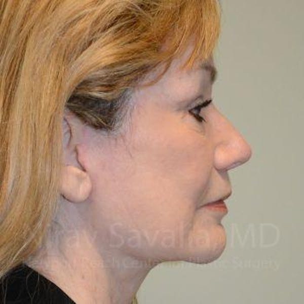 Eyelid Surgery Gallery - Patient 1655803 - Image 6