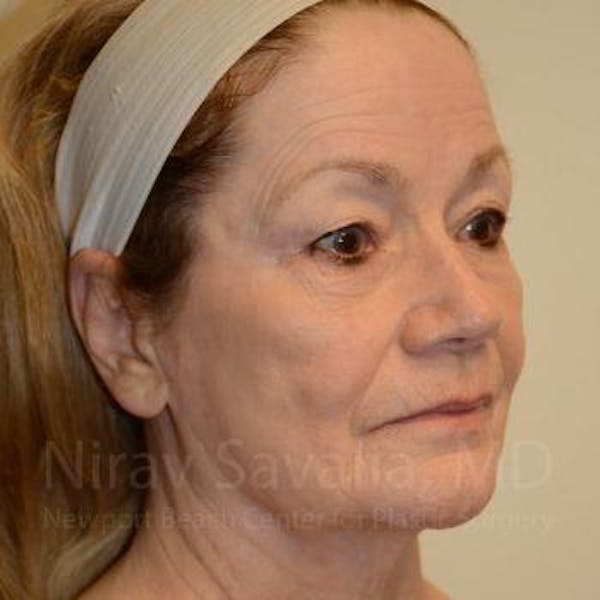 Eyelid Surgery Before & After Gallery - Patient 1655803 - Image 7