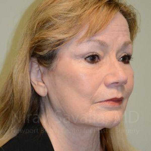 Eyelid Surgery Before & After Gallery - Patient 1655803 - Image 8