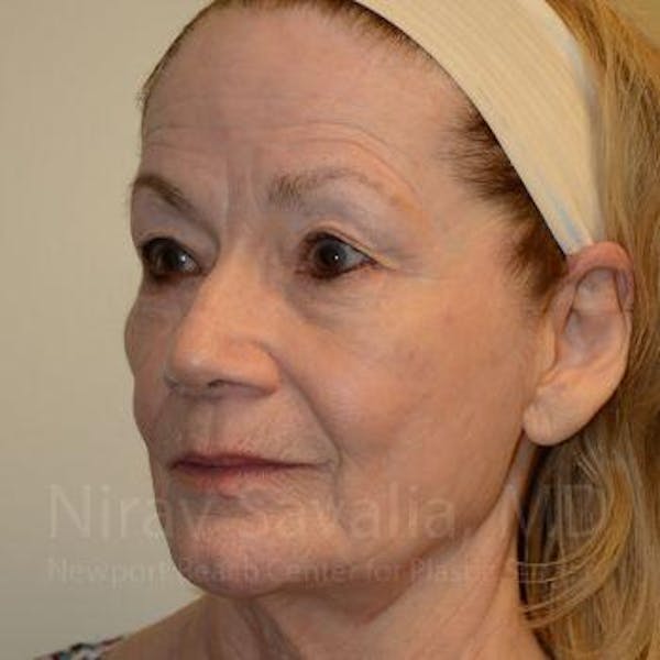 Eyelid Surgery Before & After Gallery - Patient 1655803 - Image 9