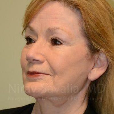 Eyelid Surgery Before & After Gallery - Patient 1655803 - Image 10
