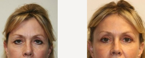 Eyelid Surgery