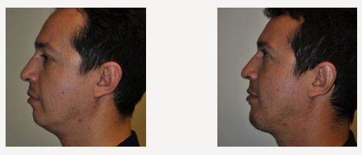 Chin Implant
