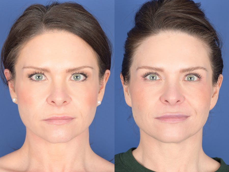 Eyelid Surgery Before and After Photos