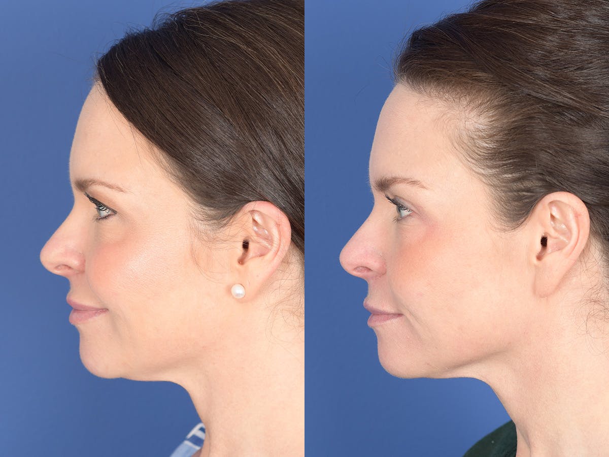 Blepharoplasty Before & After Gallery - Patient 121200 - Image 2