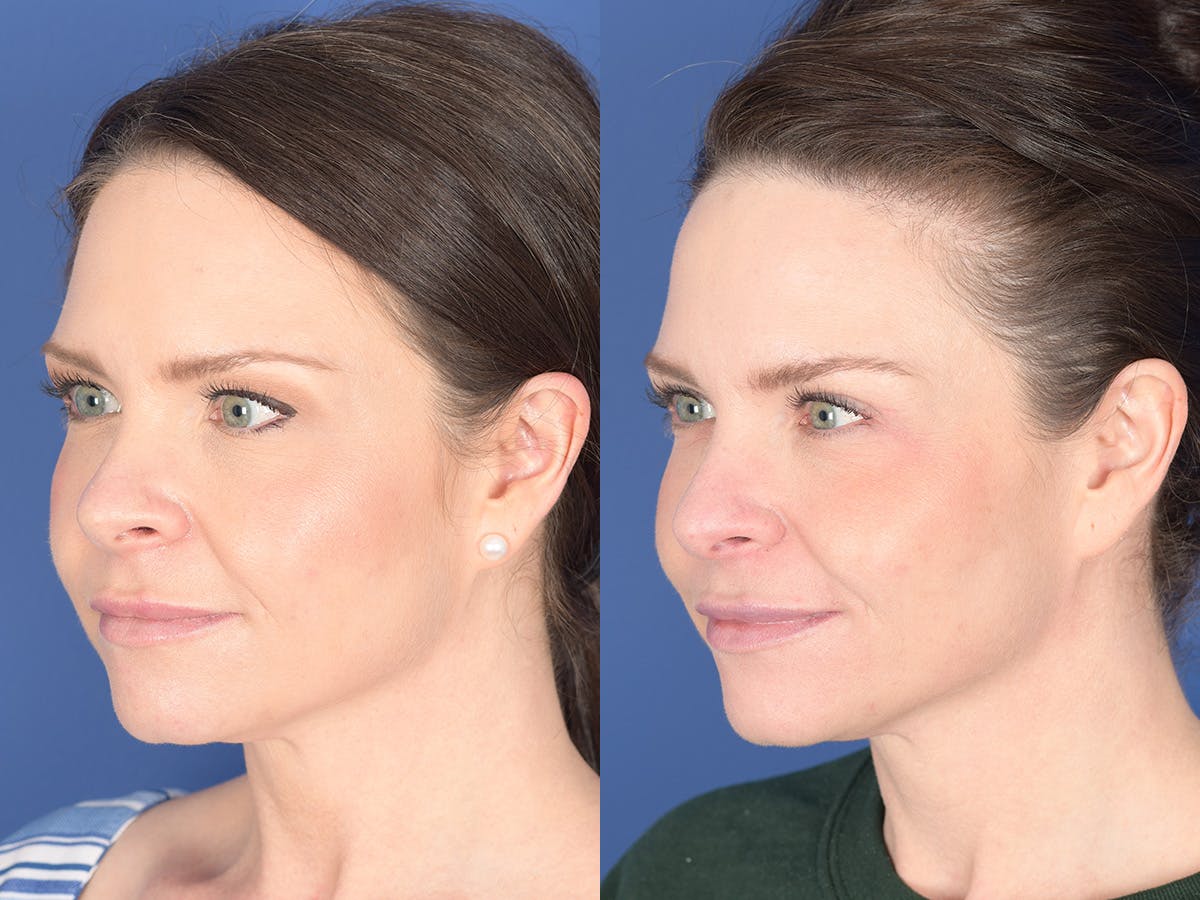 Blepharoplasty Before & After Gallery - Patient 121200 - Image 3