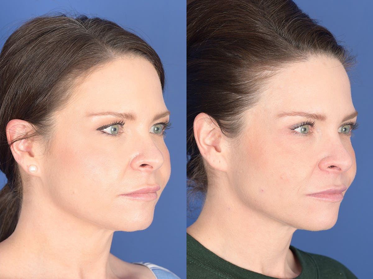 Blepharoplasty Before & After Gallery - Patient 121200 - Image 4