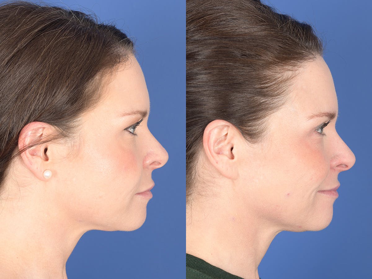 Blepharoplasty Before & After Gallery - Patient 121200 - Image 5