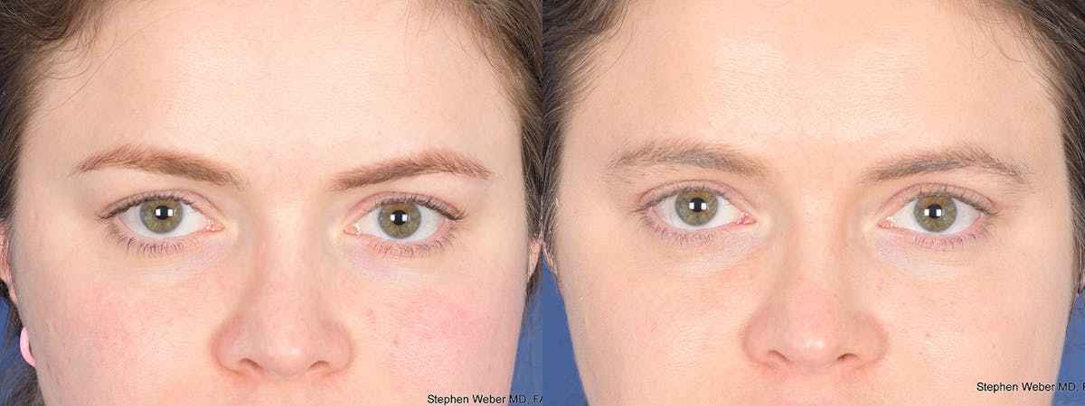 Blepharoplasty Before & After Gallery - Patient 209015 - Image 1