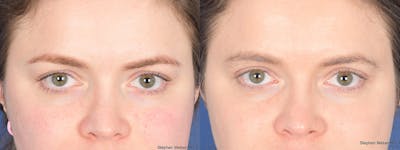 Blepharoplasty Before & After Gallery - Patient 209015 - Image 1