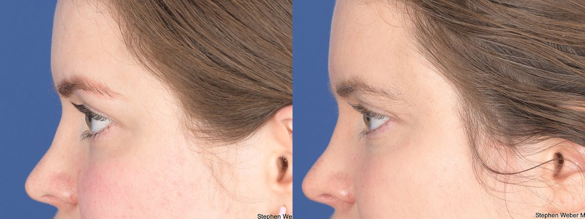 Blepharoplasty Before & After Gallery - Patient 209015 - Image 2
