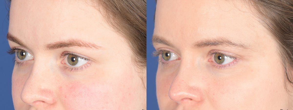 Blepharoplasty Before & After Gallery - Patient 209015 - Image 3