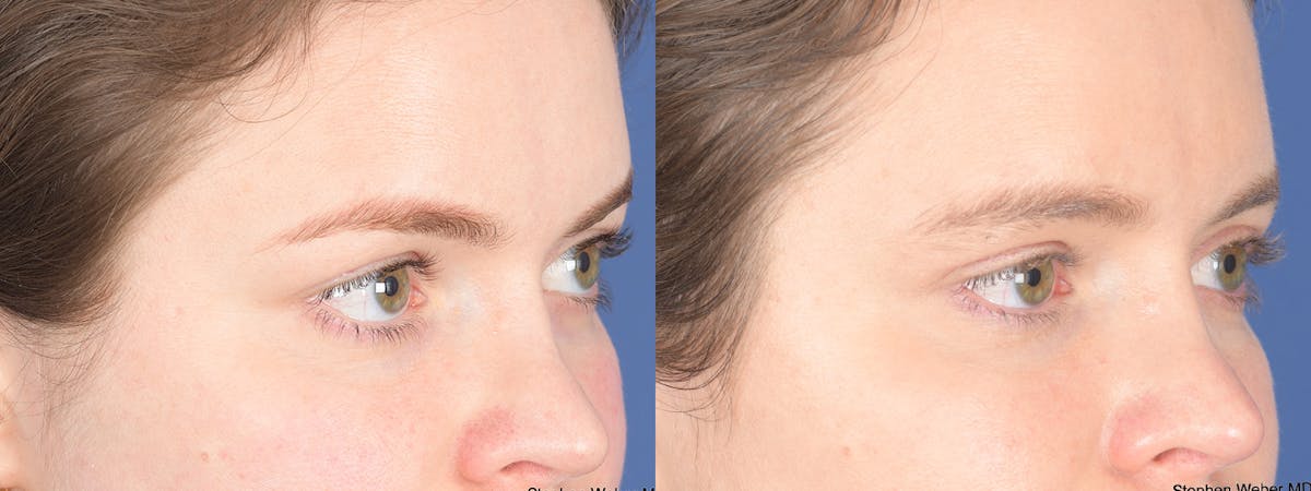 Blepharoplasty Before & After Gallery - Patient 209015 - Image 4
