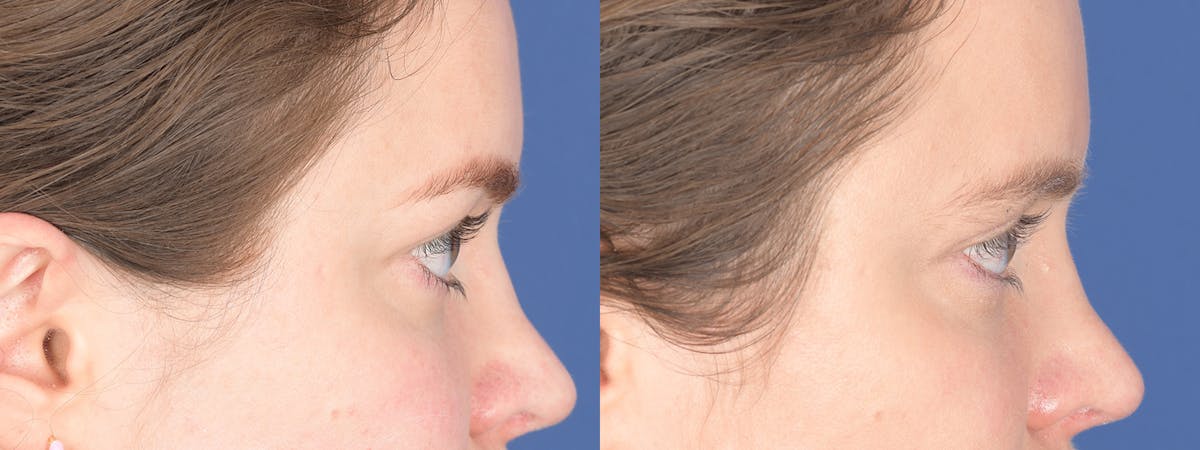 Blepharoplasty Before & After Gallery - Patient 209015 - Image 5