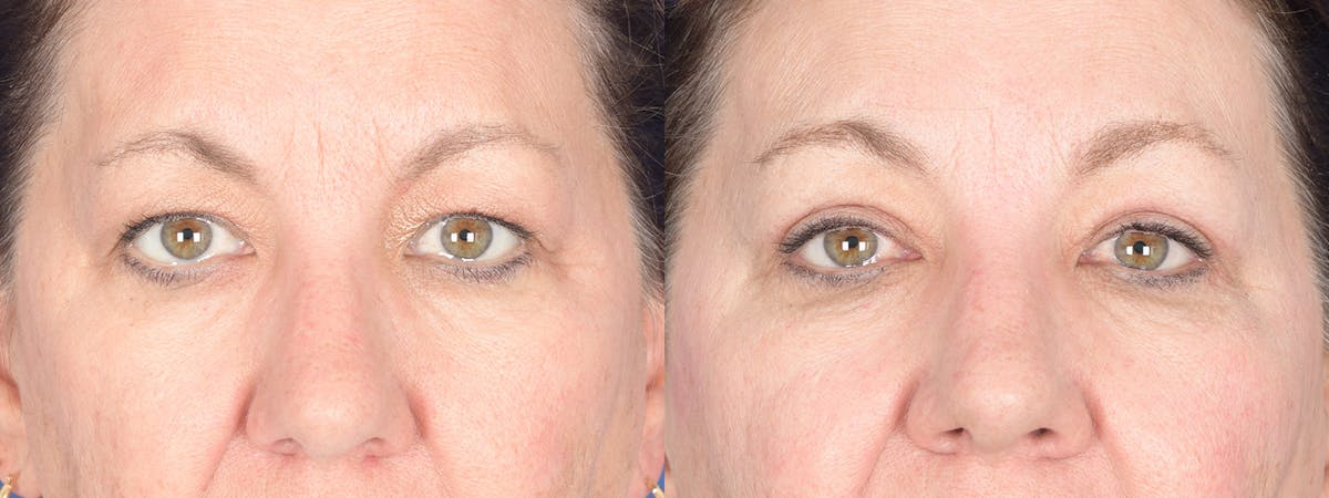 Blepharoplasty Before & After Gallery - Patient 368031 - Image 1