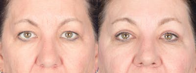 Blepharoplasty Before & After Gallery - Patient 368031 - Image 1