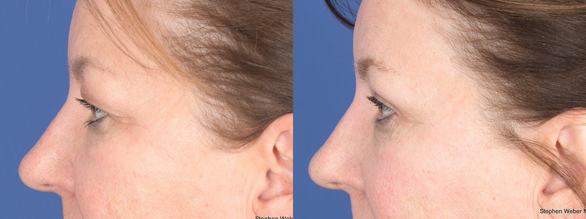 Blepharoplasty Before & After Gallery - Patient 368031 - Image 2