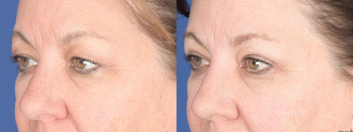 Blepharoplasty Before & After Gallery - Patient 368031 - Image 3