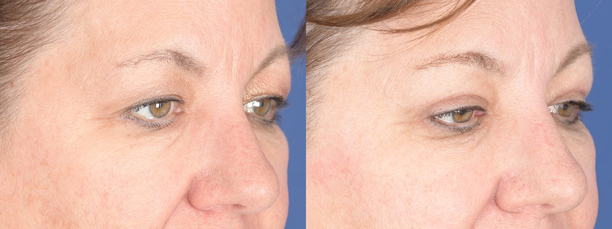 Blepharoplasty Before & After Gallery - Patient 368031 - Image 4