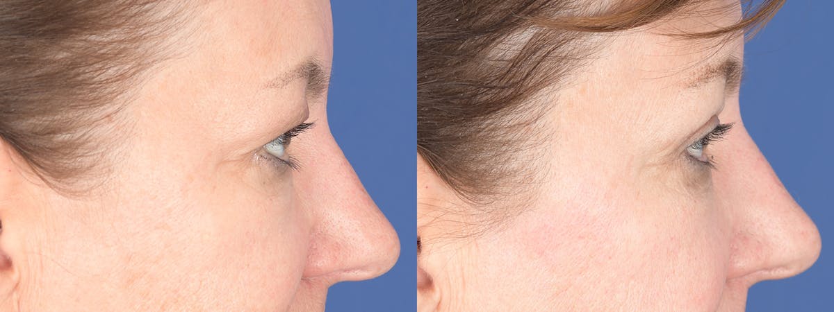 Blepharoplasty Before & After Gallery - Patient 368031 - Image 5