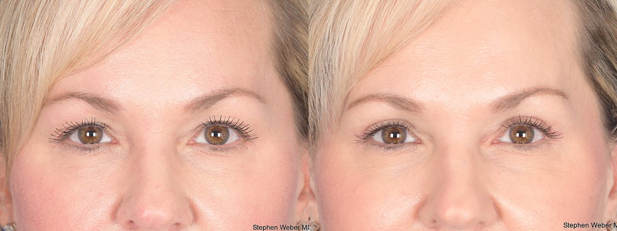 Blepharoplasty Before & After Gallery - Patient 320107 - Image 1