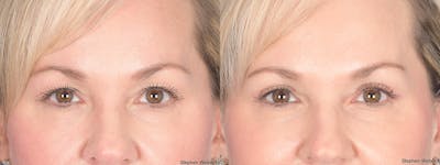 Blepharoplasty Before & After Gallery - Patient 320107 - Image 1