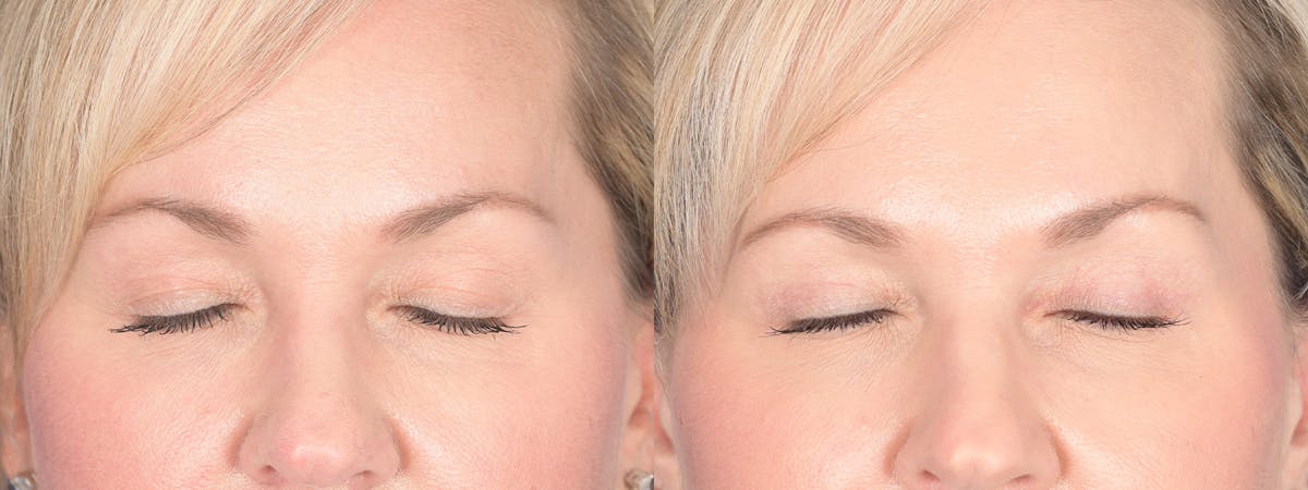 Blepharoplasty Before & After Gallery - Patient 320107 - Image 2