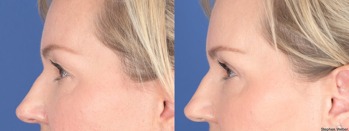 Blepharoplasty Before & After Gallery - Patient 320107 - Image 3