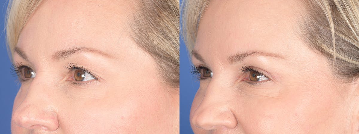 Blepharoplasty Before & After Gallery - Patient 320107 - Image 4