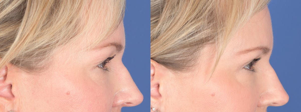 Blepharoplasty Before & After Gallery - Patient 320107 - Image 5